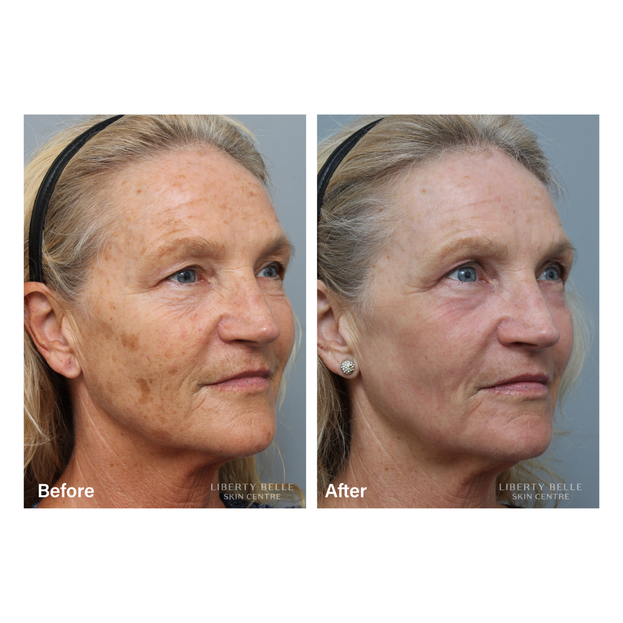 Fractional CO Laser Before & After