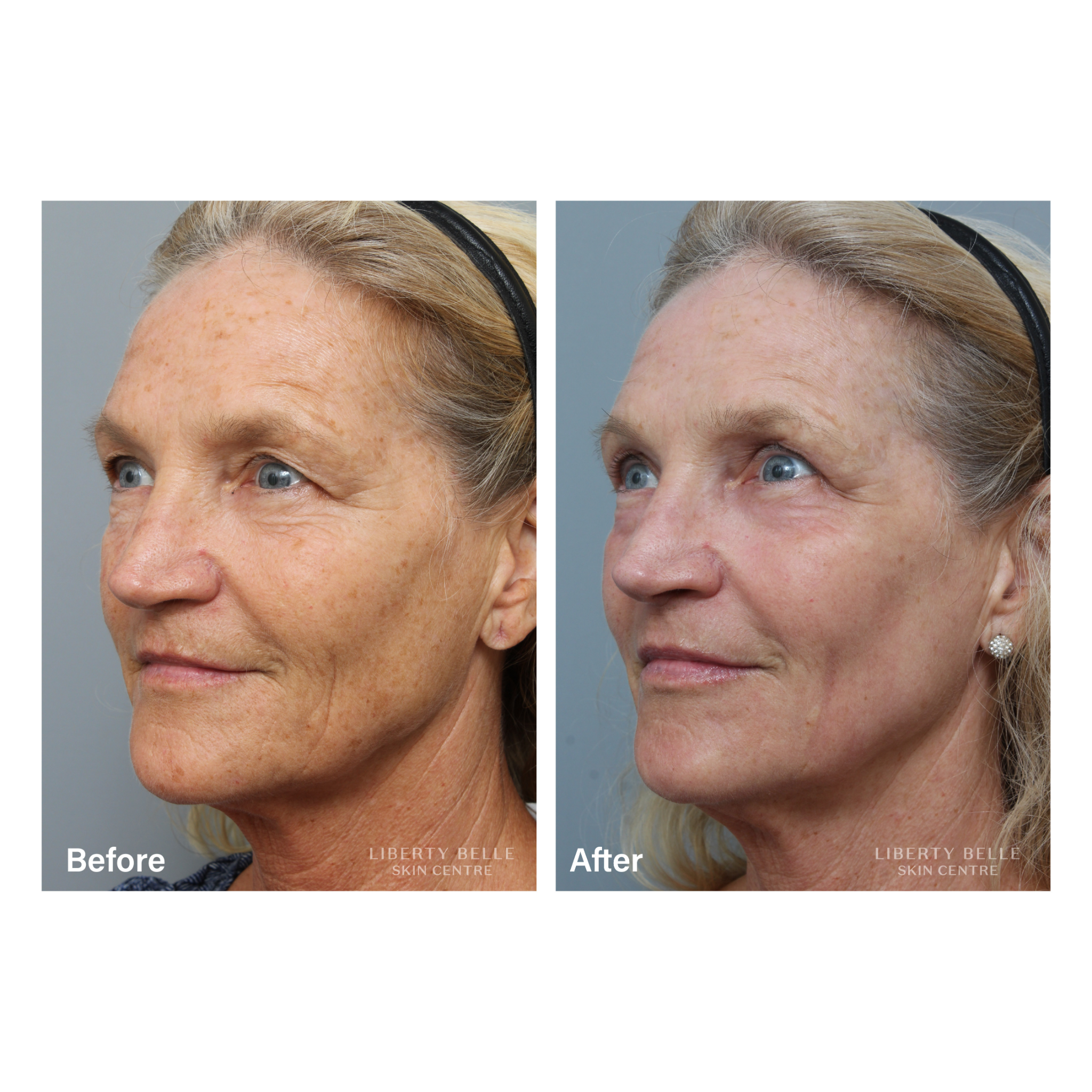 Fractional CO Laser Before & After