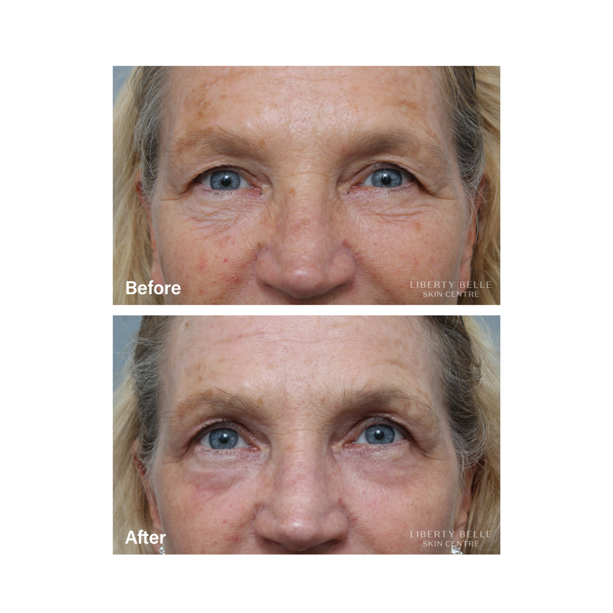Fractional CO Laser Before & After
