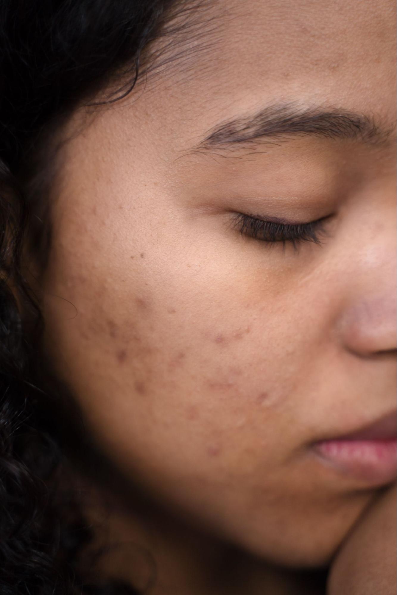 Post-Inflammatory Hyperpigmentation