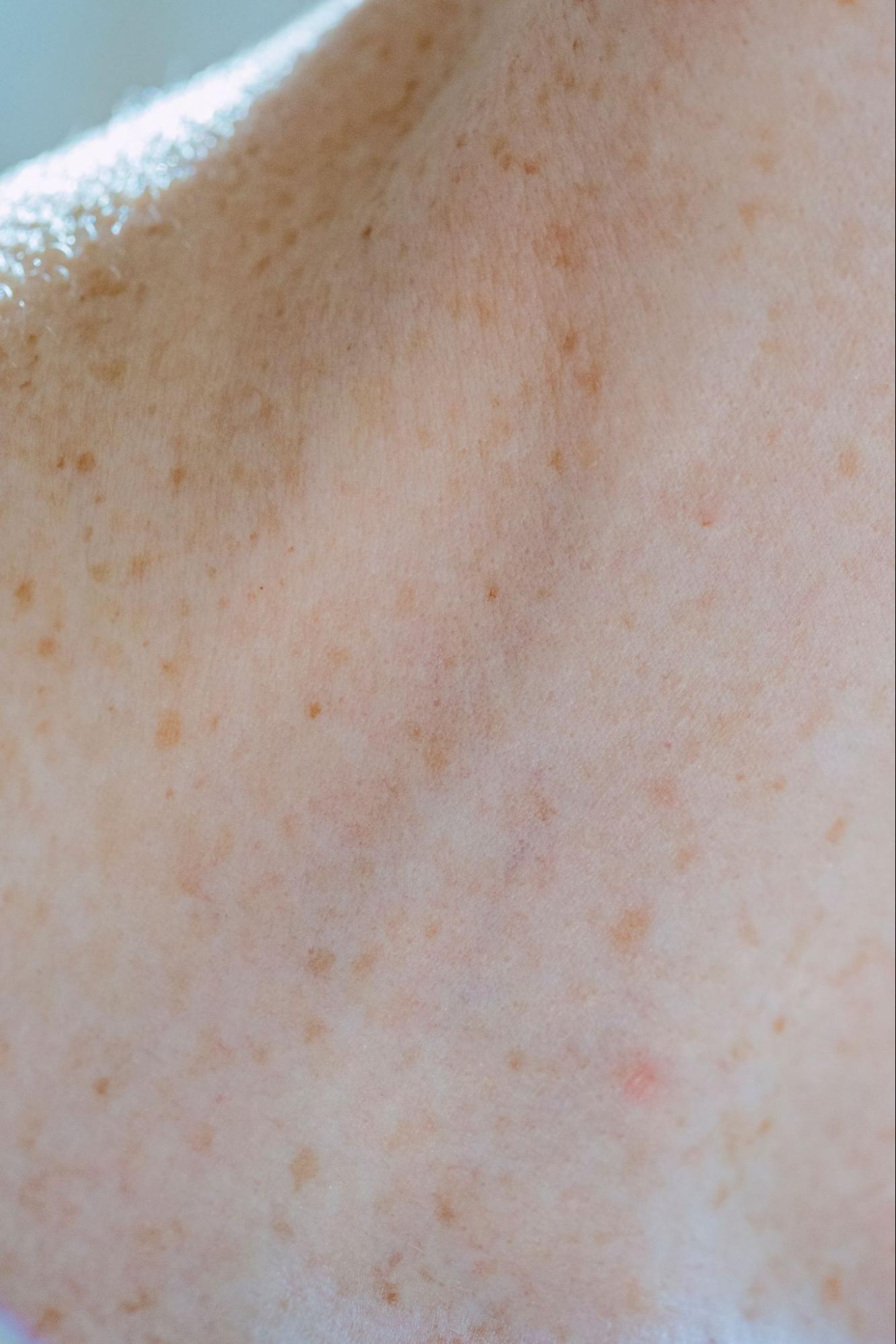 Freckles